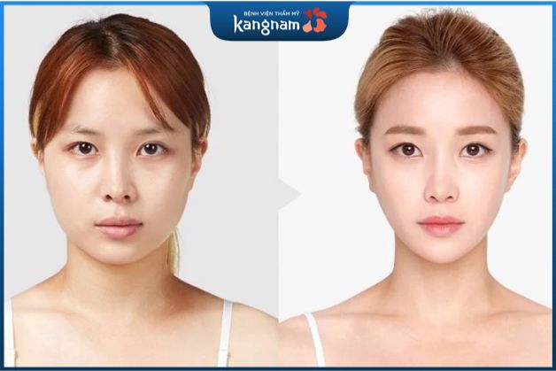 Mặt dài có nên độn cằm không còn tùy vào tình trạng mỗi người