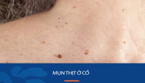 Mụn thịt ở cổ: 5 Cách xóa sổ mụn thịt nhanh chóng tại nhà