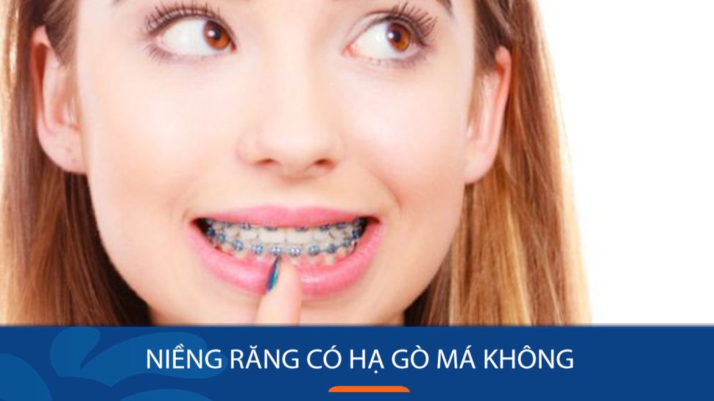 Niềng răng có hạ gò má không? Những điều cần biết