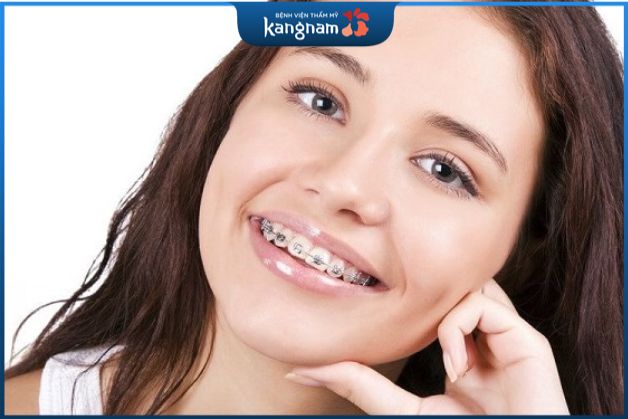 niềng răng làm hóp má khiến gò má trông cao hơn