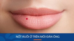 Nốt ruồi trên môi: Bí quyết xóa bỏ hoàn toàn, lấy lại vẻ đẹp tự tin