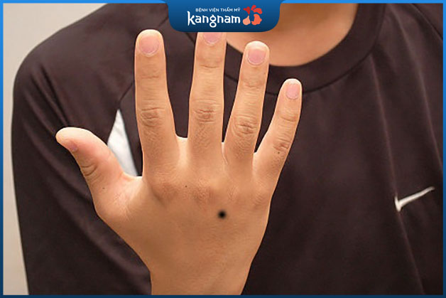 Nốt ruồi ở tay trái nam giới biểu hiện là người có cá tính mạnh mẽ