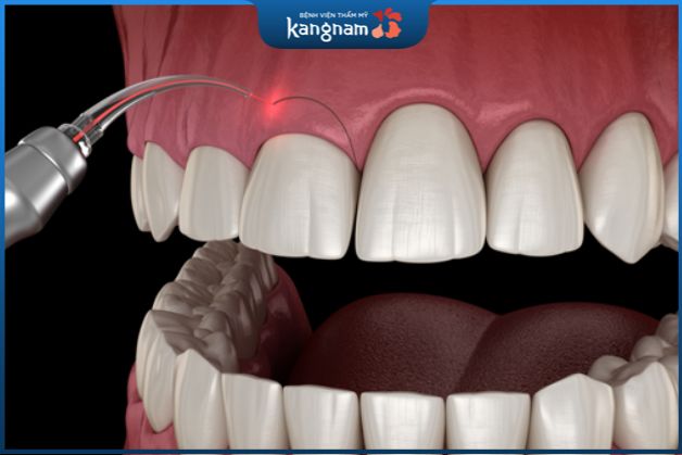 Quy trình cắt nướu chữa cười hở lợi