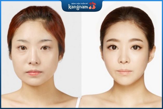 Thu gọn mặt không phẫu thuật có nhiều ưu điểm