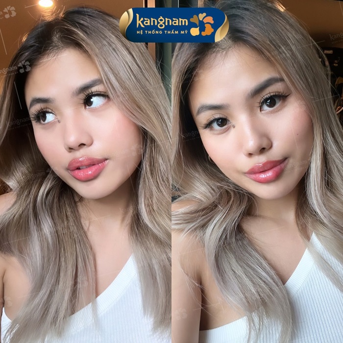 Lượng cc filler môi cần tiêm