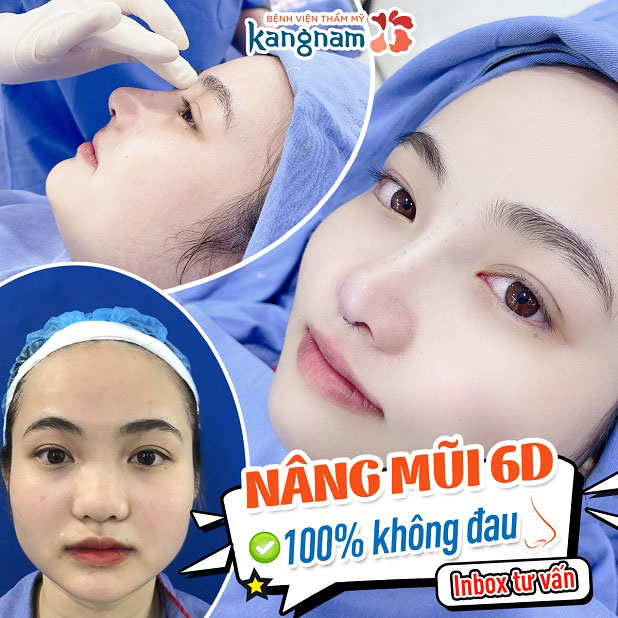 Nâng mũi 6D siêu tự nhiên