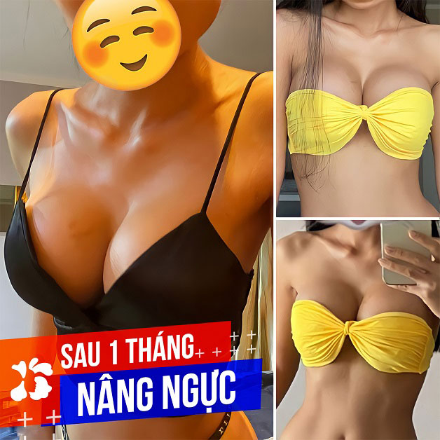 Khách hàng nâng ngực sau 1 tháng tại Kangnam