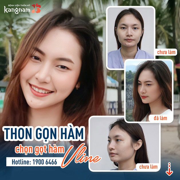 Gọt hàm vuông đau không?