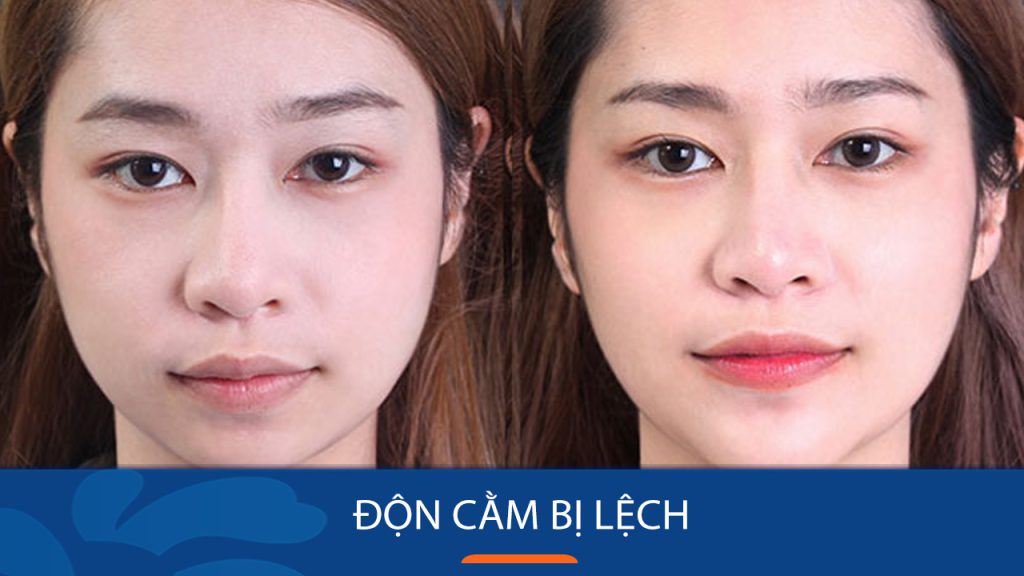 Độn Cằm Bị Lệch: 4 Nguyên Nhân và Cách Sửa An Toàn, Hiệu Quả