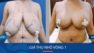 Giá thu nhỏ vòng 1 tại Kangnam – Bảng giá cập nhật