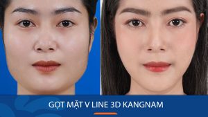 Gọt mặt V line là gì? Ai nên thực hiện, rủi ro và thời gian hồi phục