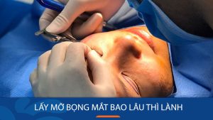 Lấy mỡ bọng mắt bao lâu thì lành? Thời gian hồi phục & cách chăm sóc đúng