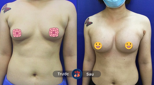 Phẫu thuật nâng ngực giấu sẹo, không ảnh hưởng đến tính thẩm mỹ