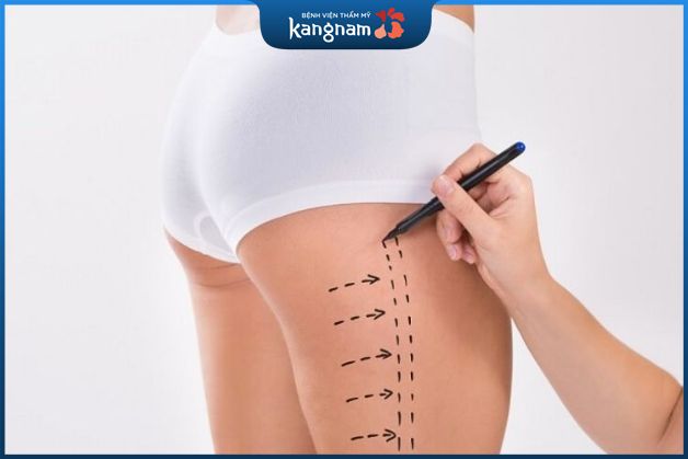 Hút mỡ bằng công nghệ cao - Cách giảm mỡ đùi cực nhanh