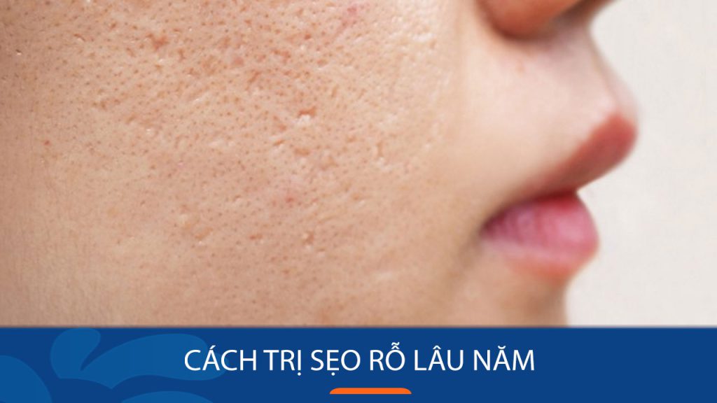 Bí quyết trị sẹo rỗ lâu lăm vĩnh viễn chỉ sau 1 liệu trình