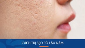 Bí quyết trị sẹo rỗ lâu lăm vĩnh viễn chỉ sau 1 liệu trình