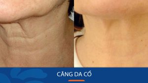 Căng Da Chỉ Vùng Cổ: Bí Quyết Xóa Nếp Nhăn, Da Chùng Hiệu Quả