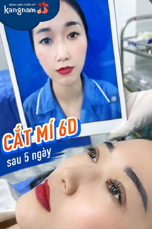 Khách hàng cắt mí 6D tại Kangnam hết sưng chỉ sau 5 ngày