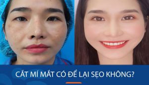 Cắt mí mắt có để lại sẹo không? Cách hạn chế sẹo hiệu quả