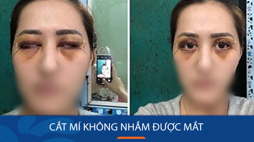 Cắt mí không nhắm được mắt có nguy hiểm không? Nguyên nhân & cách xử lý