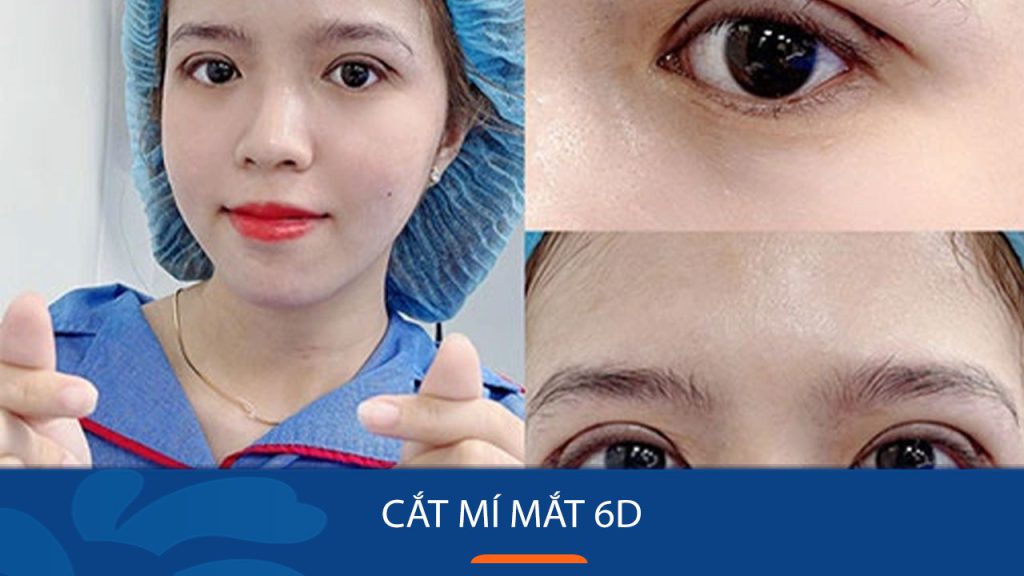 Cắt mí mắt 6D là gì? Khác gì cắt mí thông thường & có tốt không?