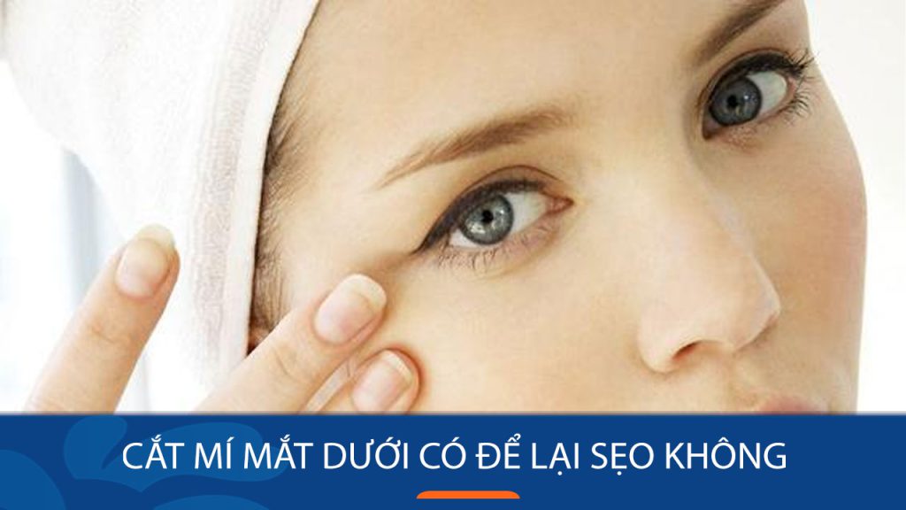 Cắt mí mắt dưới có để lại sẹo không? Giải đáp & cách hạn chế sẹo