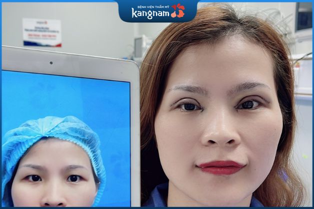 Mắt sưng sau khi cắt mí là hiện tượng bình thường