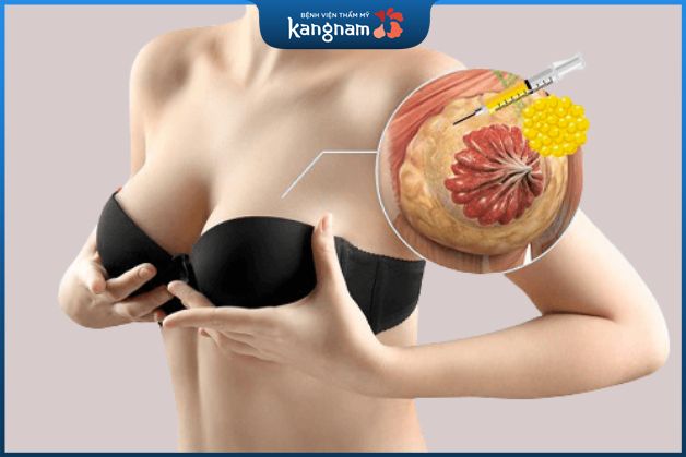 Độ loa không phẫu thuật bằng cách cấy mỡ tự thân