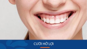 Cười hở lợi là gì? Dấu hiệu, nguyên nhân và cách điều trị hiệu quả
