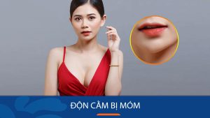 Độn cằm bị móm là gì? Nguyên nhân và cách khắc phục an toàn
