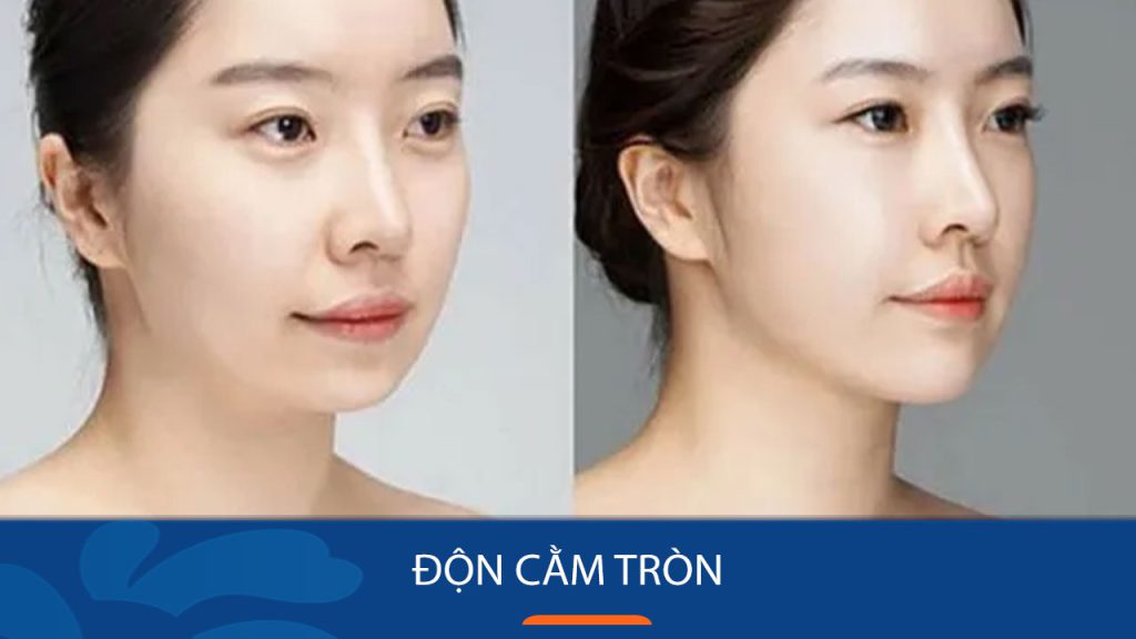 Độn cằm tròn là gì? Phương pháp thực hiện, độ bền và chi phí