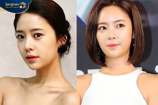 Độn trán giúp làm đầy vùng trán lõm, ngắn, trẻ hóa da toàn diện