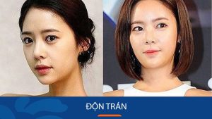 Độn trán là gì? Các phương pháp phổ biến, đối tượng phù hợp và lưu ý an toàn