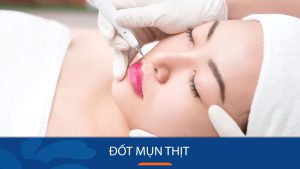Đốt Mụn Thịt Laser CO2 Fractional: Giải Pháp Hiệu Quả Cho Làn Da Mịn Màng