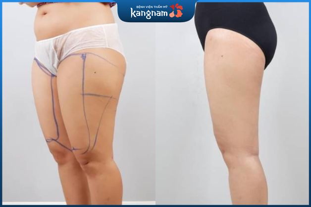 Hút mỡ đùi tại Kangnam
