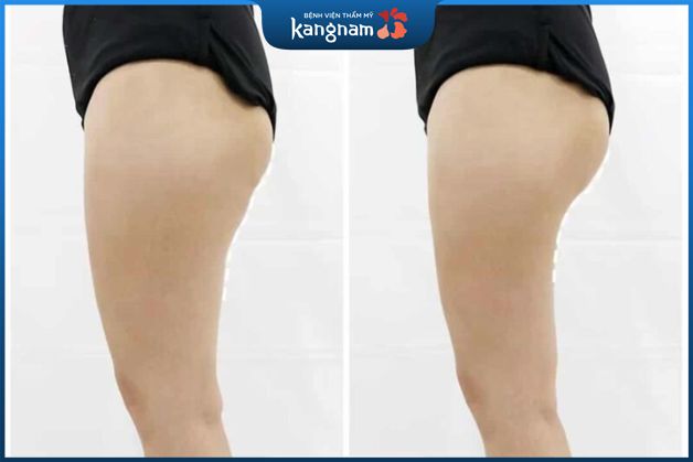 Giảm mỡ đùi chỉnh hình đường nét đôi chân thon gọn, vòng 3 nở nang