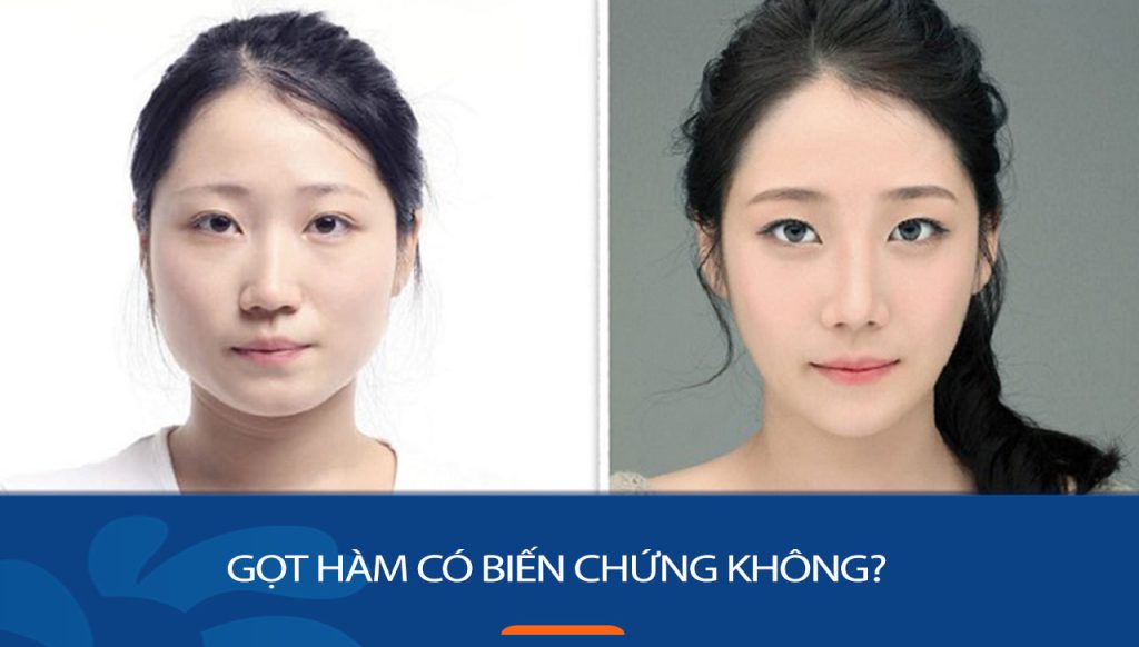 Gọt hàm có biến chứng không? Những rủi ro có thể gặp và cách phòng tránh