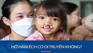 Nguy cơ di truyền hở hàm ếch: Cần biết để bảo vệ con