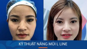 Nâng mũi L Line: Bí quyết sở hữu dáng mũi hoàn hảo
