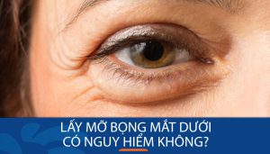 Lấy mỡ bọng mắt dưới có nguy hiểm không? Rủi ro & cách đảm bảo an toàn