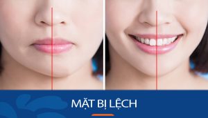 Mặt bị lệch: Nguyên nhân, tác động và cách khắc phục