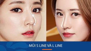 Mũi S Line và L Line: So sánh chi tiết & nên chọn dáng mũi nào?
