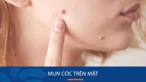 4 Cách Loại Bỏ Mụn Cóc Trên Mặt Đơn Giản Tại Nhà