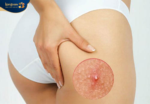 Mụn ở mông, vùng kín