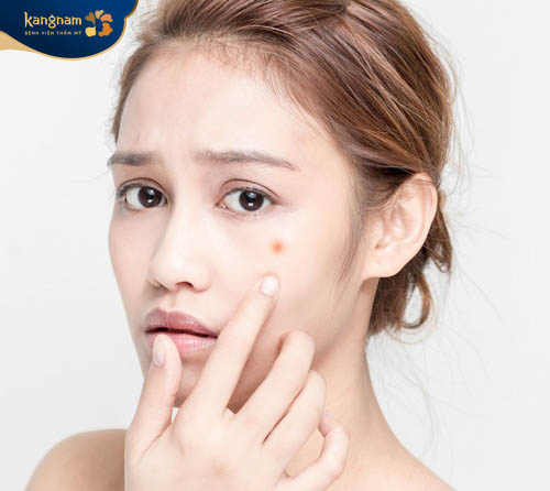 Mọc mụn ở gò má