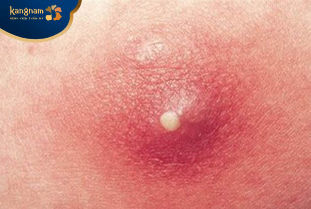 Mụn trứng cá ở mông có tự hết không?