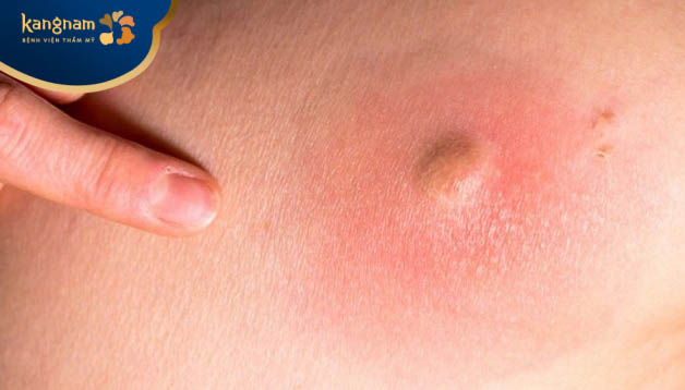 Biểu hiện bị nổi mụn nhọt mọc vùng mông