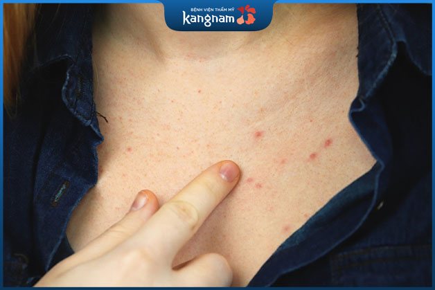 Tình trạng nổi mụn trứng cá, mụn bọc ở khe ngực