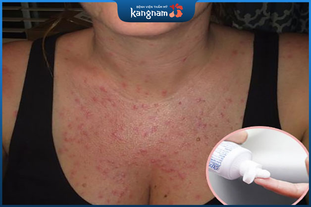 Cần phải hỏi ý kiến của bác sĩ trước khi sử dụng kem trị mụn