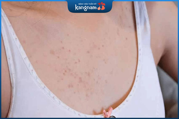Mụn ở ngực không gây hại nhưng báo hiệu nội tiết tố ảnh hưởng